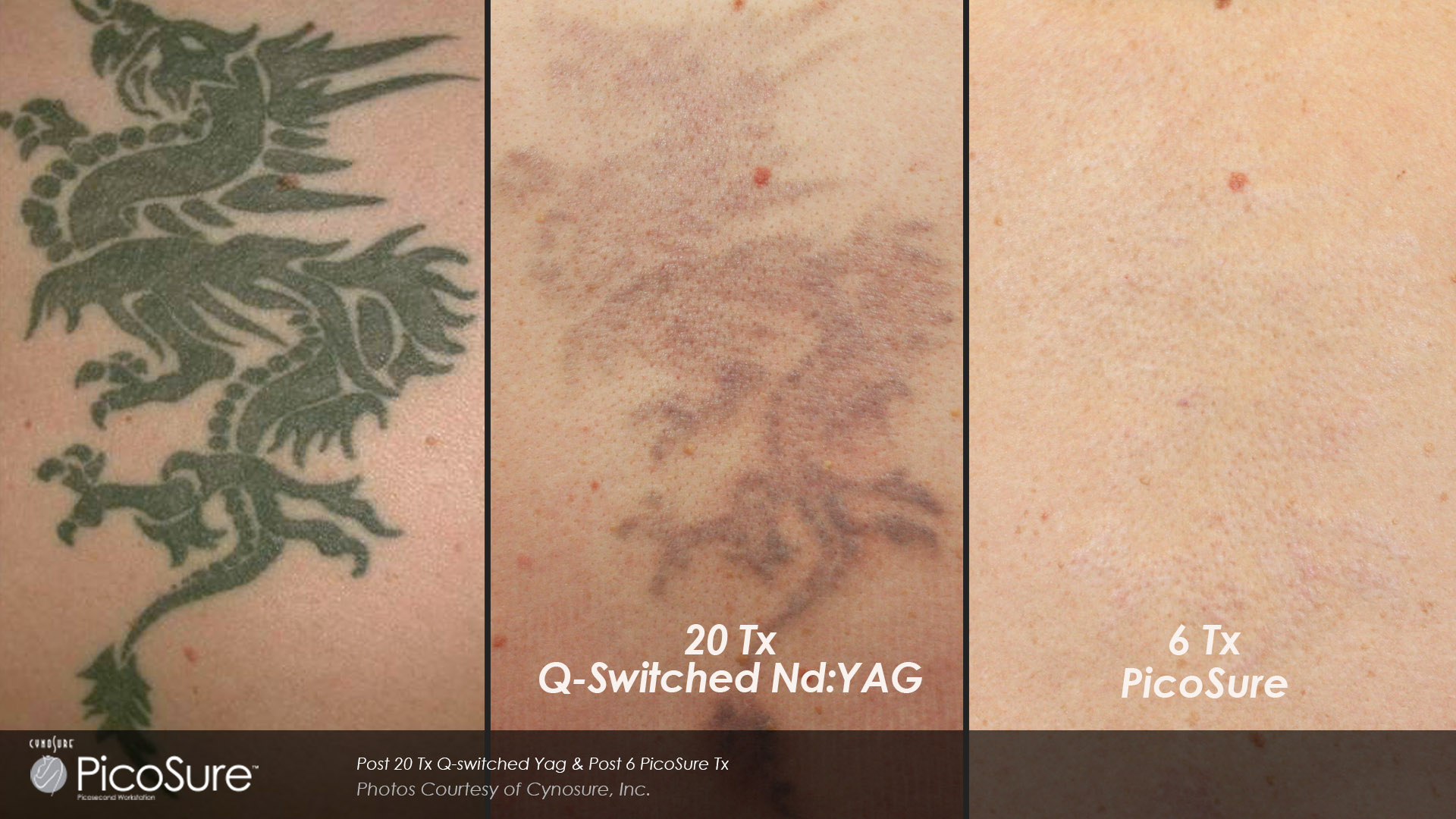 Laser Tattoo Removal | Chattanooga, TN | Shire Facial Plastic Surgery